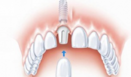种植牙视频,从术前准备到术后护理
